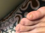 Ломкие, отслаивающие ногти на ногах фото 2