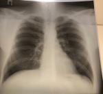 Бронхиальная астма, бронхит или пневмония? фото 1