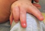 Покраснел палец на руке у грудничка фото 1