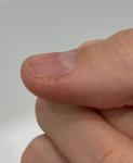 Чёрная точка на ногте, болит палец фото 2