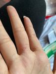 Меж пальцев болячка более месяца фото 1