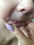Воспалённое Образование на губе у ребёнка, когда трогаешь ребёнку больно фото 2