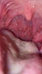 Болит горло (опухло миндаль и появились белые точки фото 1
