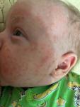 Акне новорожденных или аллергия? фото 1