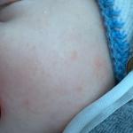 Сыпь на лице младенца фото 1