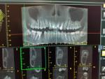 Восстановление нерва после удаления зуба фото 1