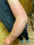 Красная кожа на руке с лимфостазом фото 1