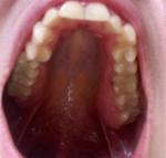Опухла десна возле леченного раннее зуба мудрости фото 1
