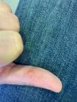 Небольшие шишки на пальцах фото 3