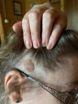 Кожное образование волосистой части головы фото 1