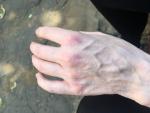Покраснение шелушение и зуд костяшек руки фото 1
