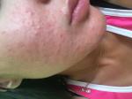 Аллергическая сыпь на лице фото 2