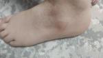 Сухой участок кожи на ноге более 5 лет фото 1