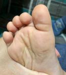 Белые точки на пятке и пальцах ноги фото 3