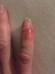 Инфекция Опух и покраснел палец после пореза болезненность бактерии фото 1