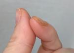 Трещины на коже, утолщение под ногтями пальцев рук фото 4