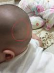 Пятно на голове у 5 месячного ребёнка фото 1