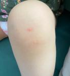 Сыпь на коленях у ребёнка фото 1