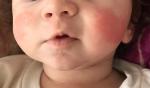 Красные щеки у малыша без прыщиков фото 1