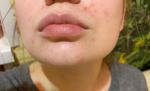 Красные высыпания в области рта, носа, фото 1