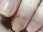 На ногте появилось покраснение в области ногтевой лунки фото 1