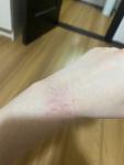Сухой участок на руке, как аллергия фото 4