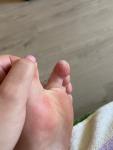 Облазит кожа на пальцах ног фото 1