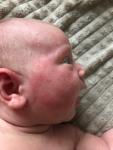 Сыпь у новорождённого фото 1