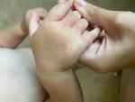 Высыпания на коже ребенка на одной руке, над верхней губой фото 1