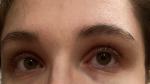Осложнение на глаза после аллергии фото 3