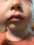 Белое пятно на нижней губе у ребёнка фото 2