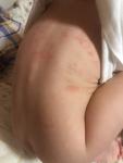 Красные пятна на теле у ребёнка с точками фото 1