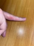 Сыпь, проявления на пальцах руки, красные участки кожи, пупырышки фото 1