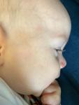 Кинбурн красные прыщики на лице у ребёнка 8 месяцев фото 1