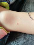 Твёрдая безболезненная шишка на ноге у ребёнка фото 1