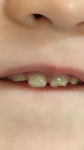 Подскажите пожалуйста, что это такое с зубами? фото 1