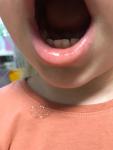 Белое пятно на нижней губе у ребёнка фото 3