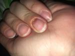 Заболевания ногтей, отсутствие ногтя у основания фото 2