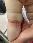 Сыпь у ребенка атонический дерматит аллергия фото 2
