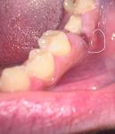 Боль в десне спустя неделю после удаления зуба фото 2