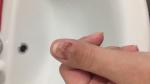 Как остановить скручивание ногтя после повреждения? фото 2