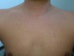 Мелкая красная сыпь на груди фото 3