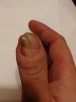 Коррекция ногтевой пластины фото 3