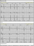 Холтеровское мониторирование, СА-блокады 2 степени фото 3