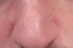 Красные пятна с двух сторон у носа, шелушение фото 3