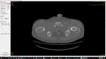 Энхондрома шейки левой бедренной кости фото 2