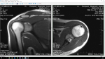 Расшифровка МРТ левого плечевого сустава фото 3