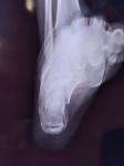Перелом пятки правой ноги фото 3