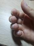 Проблемы с кожей на пальцах рук вокруг ногтей фото 3