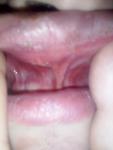 Гематома на лице и верхней губе, боль в ухе фото 3